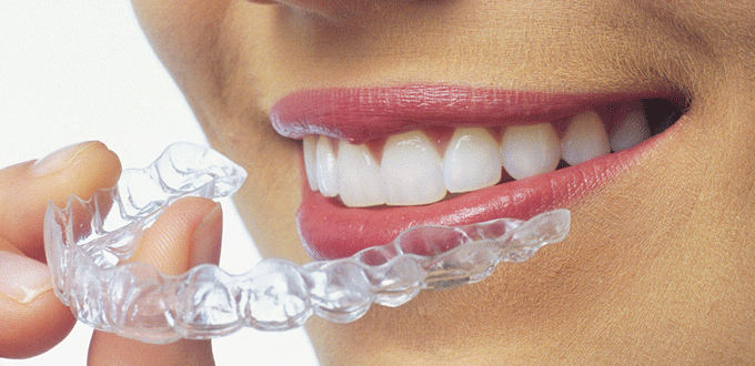 Niềng răng không mắc cài Invisalign