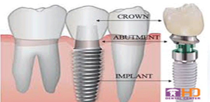 Hệ thống Implant sử dụng