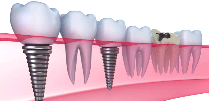Quy trình cấy ghép Implant