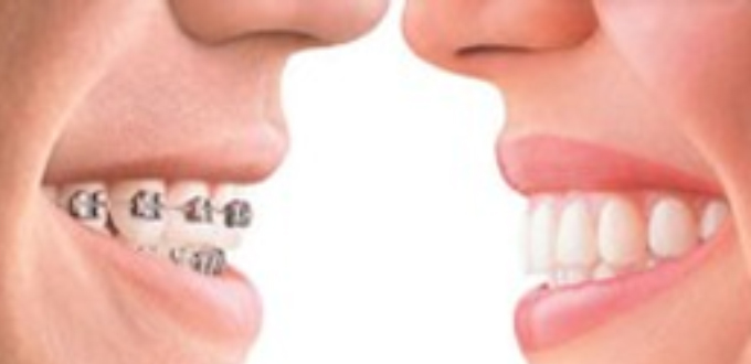 Braces procedure