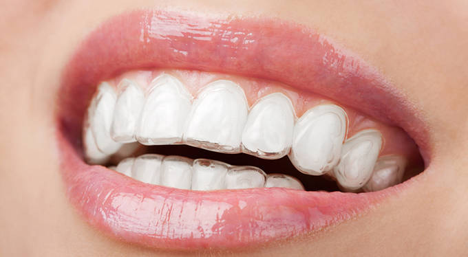 Báo ngoisao.net – Niềng răng không mắc cài Invisalign