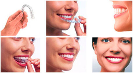 invisalign-drhung