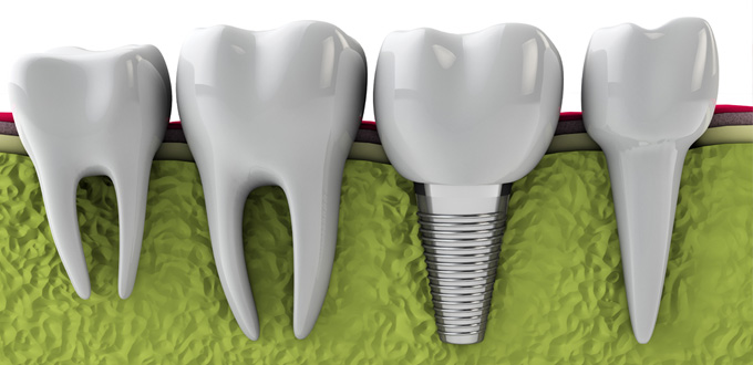 Những câu hỏi thường gặp về Implant nha khoa