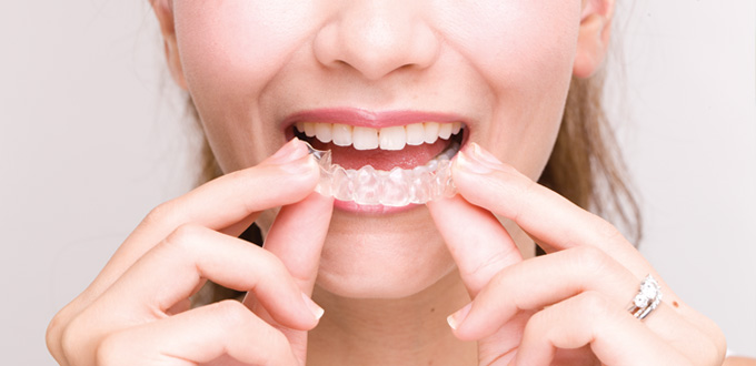 Những câu hỏi về Invisalign