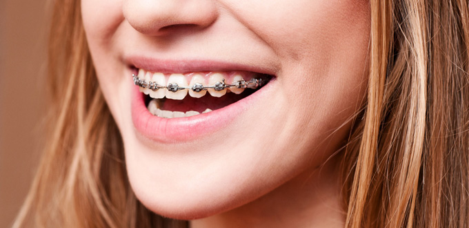 Các câu hỏi thường gặp khi niềng răng
