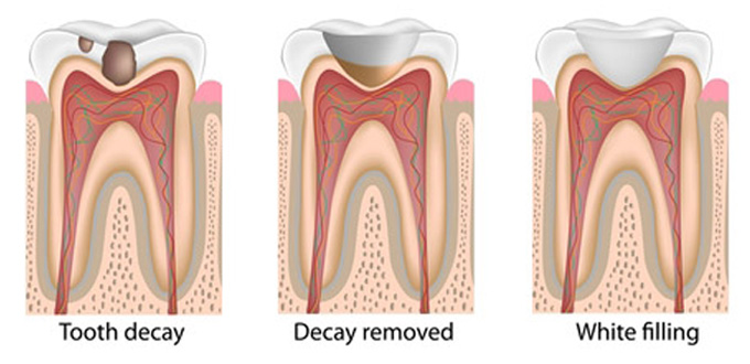 Compare Fillings vs. Crowns
