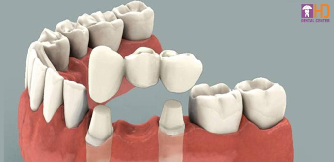 3 GIẢI PHÁP THAY THẾ KHI BỊ MẤT RĂNG