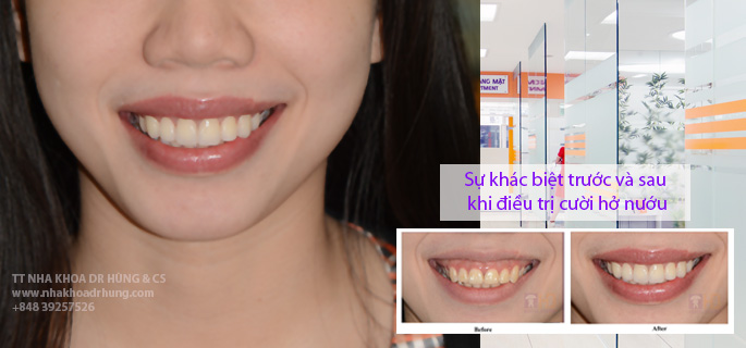 Điều trị cười hở nướu