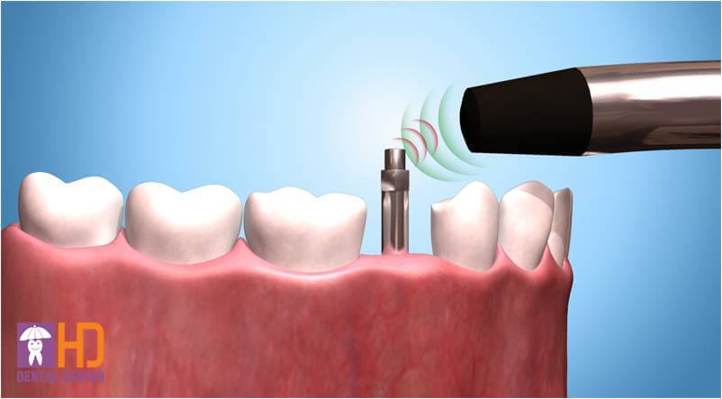 IMPLANT NHA KHOA
