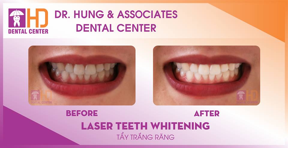 Tấy trắng răng - nha khoa uy tín