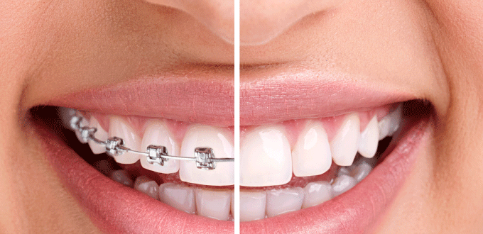 Các loại mắc cài niềng răng