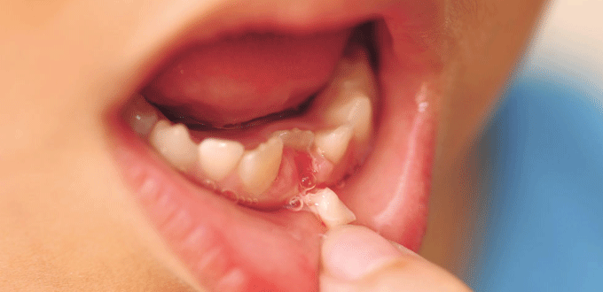 Chữa tủy răng sữa