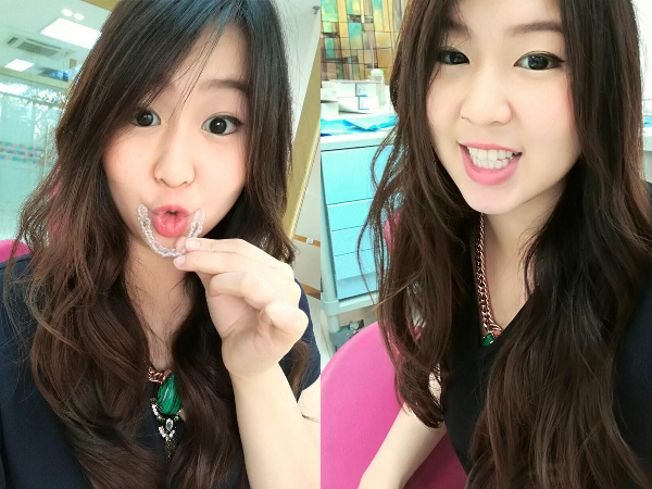 Invisalign – Niềng răng không mắc cài