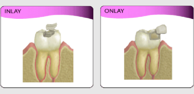 Inlay – onlay