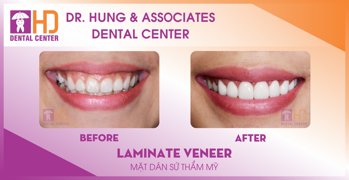 Veneer