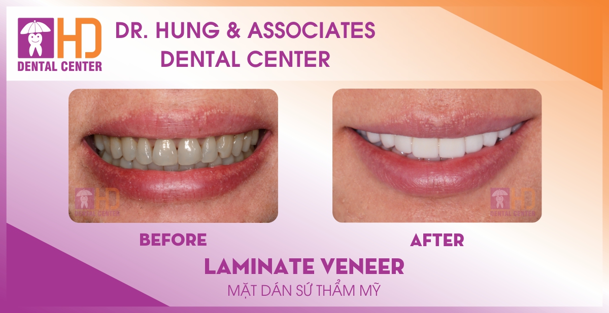 Veneer
