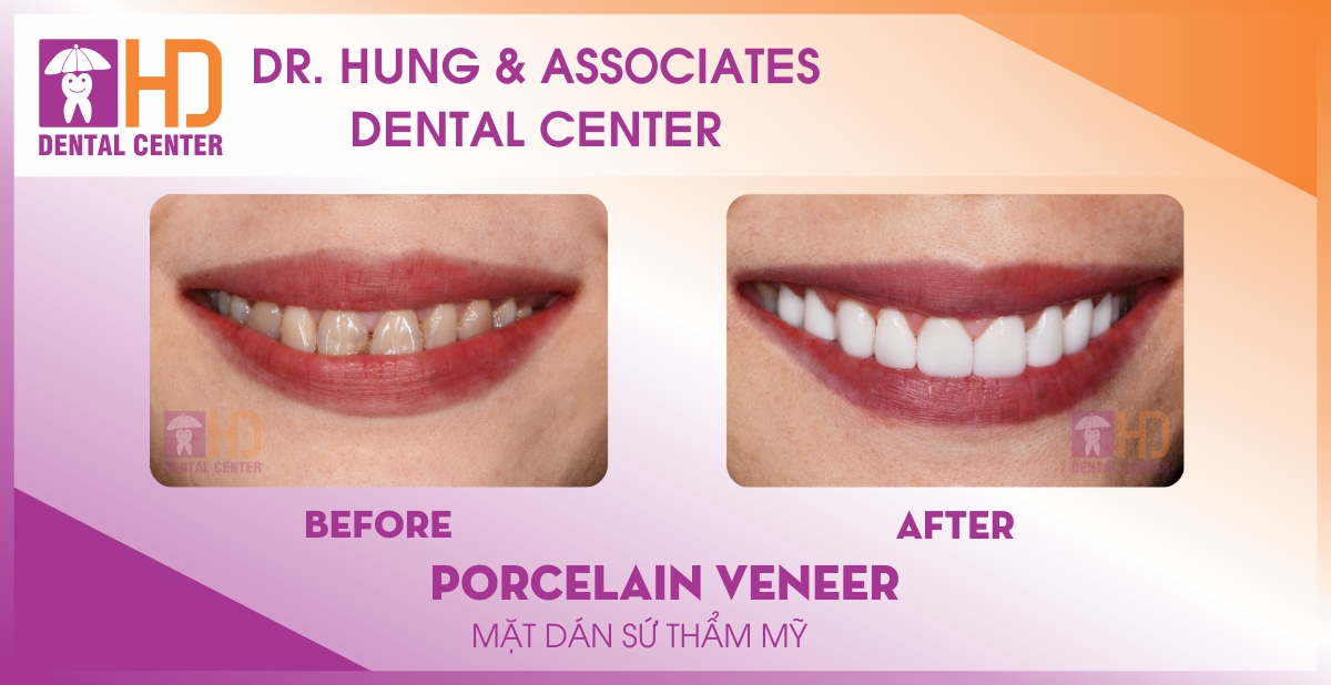 Veneer
