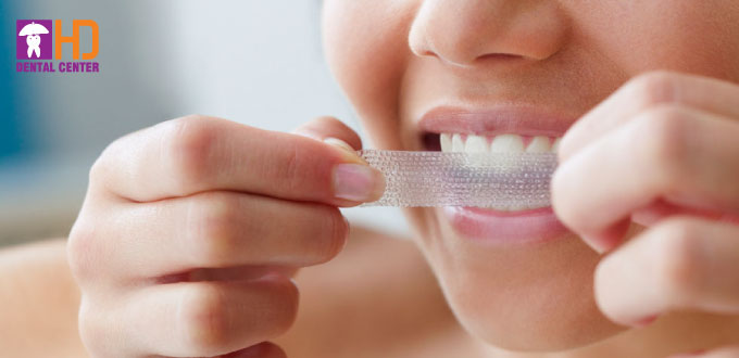 NGUY HIỂM TIỀM TÀNG TỪ MIẾNG DÁN TRẮNG RĂNG CẤP TỐC.