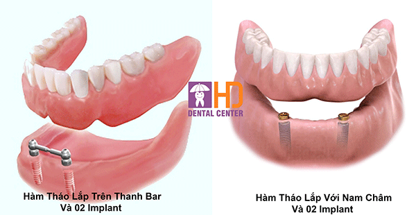 ham-thao-lap-02-implant