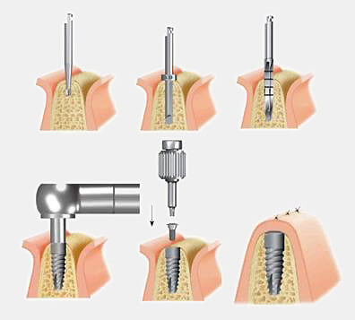Quy trình phẫu thuật cấy implant