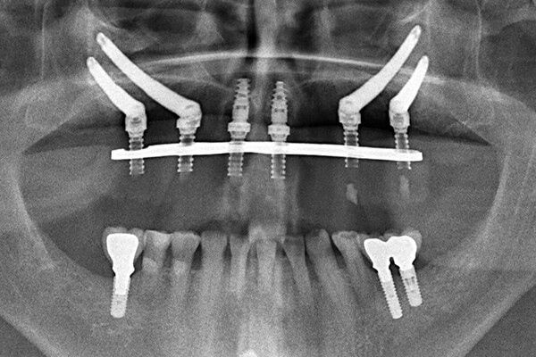 (Hình X-Quang của một ca cắm ghép Zygoma Implant)