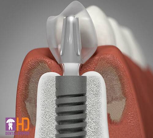 Đặt Implant tức thì sau nhổ răng