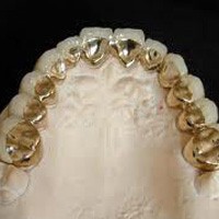 Răng sứ-kim loại quý