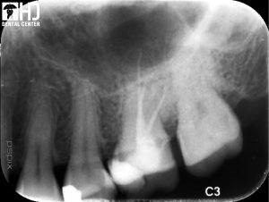 Hình 01: Điều trị tủy răng bằng trâm KFile