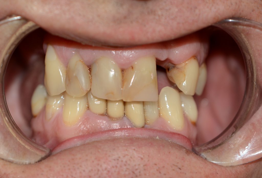 Cấy ghép Implant (Implant placement)