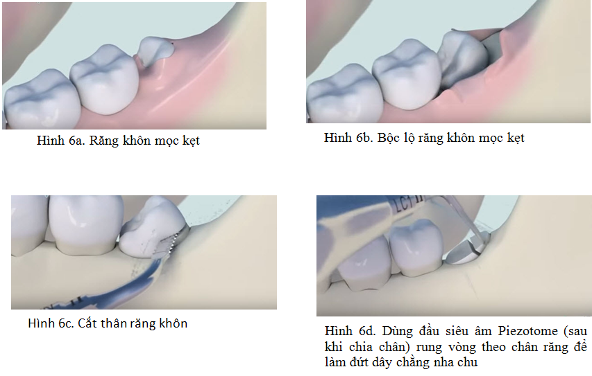 Qui trình nhổ răng khôn với máy siêu âm Piezotome