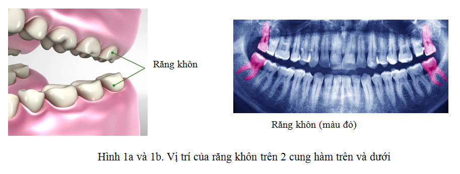 Răng khôn (Wisdom teeth)