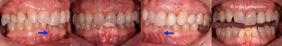 Frenum-pull-frein-recession-gingivale-orthodontie-536379-GH-661