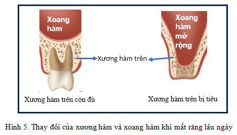 Sự liên quan giữa xương hàm và xoang hàm