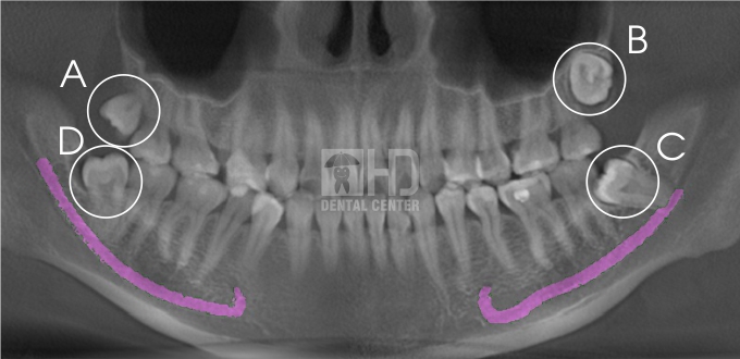 Khách hàng được chỉ định chụp Phim CT Conbeam