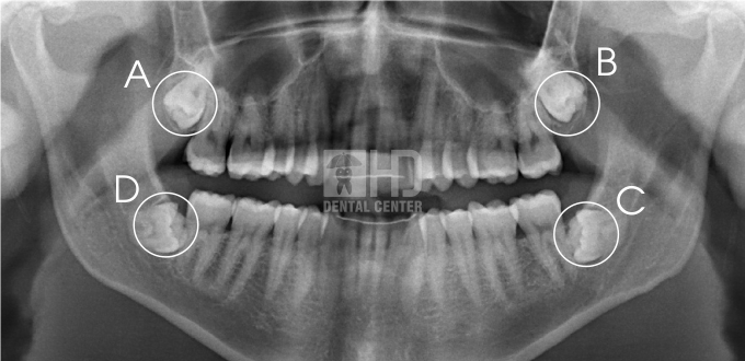 Một số ca nhổ răng khôn điển hình tại TT nha khoa Dr Hùng & cộng sự