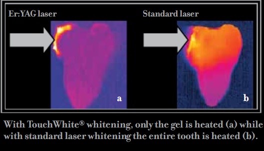 Với LIGHTWALKER chỉ lớp gel bị làm nóng (a), trong khi đó với laser thông thường, toàn bộ răng bị làm nóng.