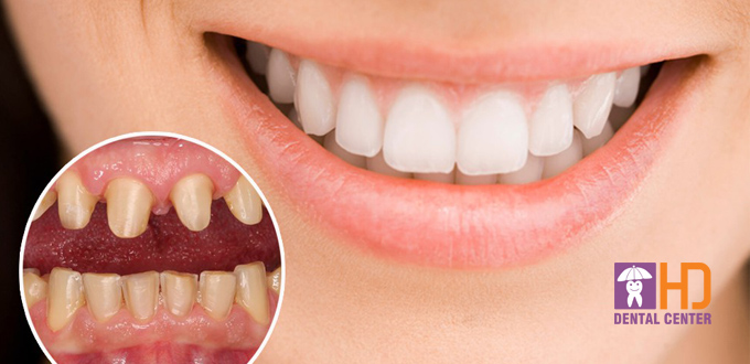 Răng sứ thẩm mỹ có thực sự tốt không?