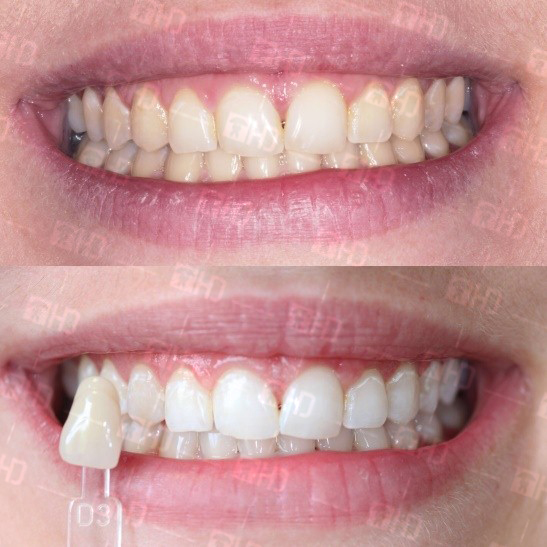 Điều cần biết khi tẩy trắng răng là gì?