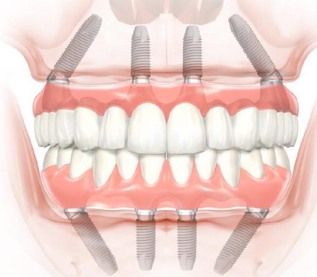 Giải pháp Implant cho người mất răng toàn hàm
