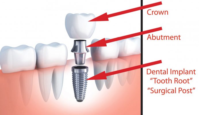 Implant nha khoa là gì?