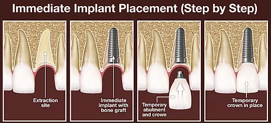 Thời gian nào tốt nhất đặt implant sau khi nhổ răng