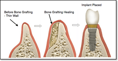 Đặt implant trì hoãn kết hợp ghép xương, màng xương