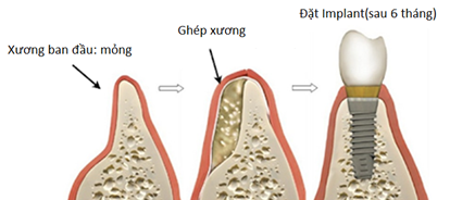 Ghép xương trong trường hợp không đủ xương (chờ 6 tháng)