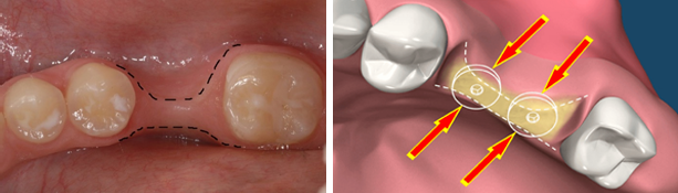 Hình ảnh: Tiêu xương quá mức do mất răng lâu ngày, không đủ thể tích cho đặt nha khoa Implant