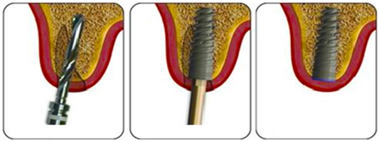 Trồng răng implant thay thế răng mất