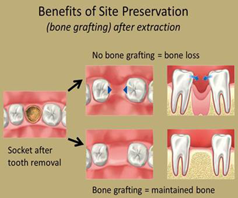 Ghép xương răng: lợi hay hại?