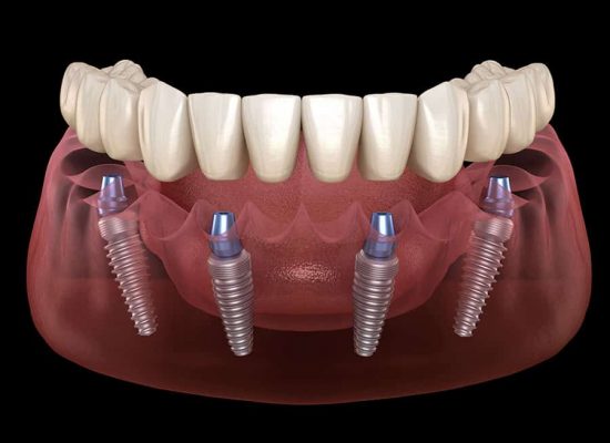 6 bước quy trình cấy ghép răng implant là gì?