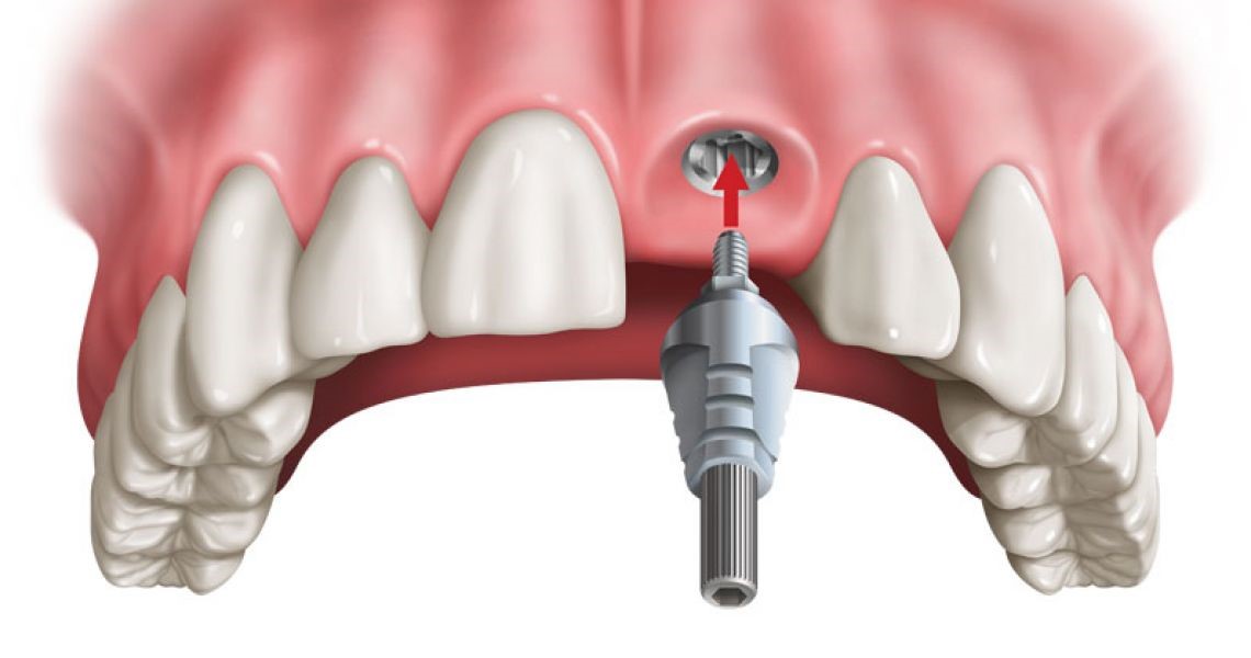 Dịch vụ cắm implant răng cửa chất lượng