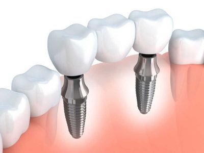 Chi phí cấy ghép răng Implant mất bao nhiêu tiền?