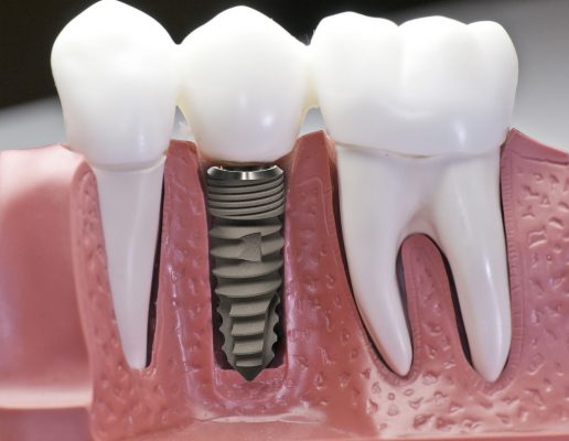 Cấy ghép răng Implant ở đâu tốt